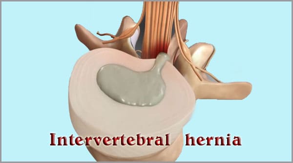 Disc herniation